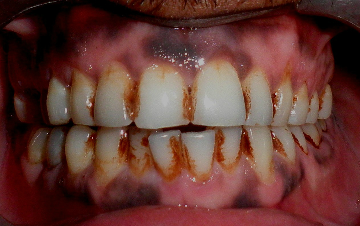 The yellow stains on teeth க்கான பட முடிவு