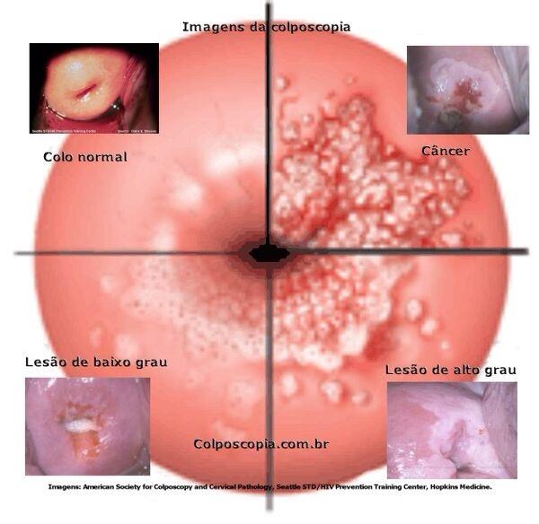 LESIONES EN EL CUELLO UTERINO lesiones en el cuello uterino: