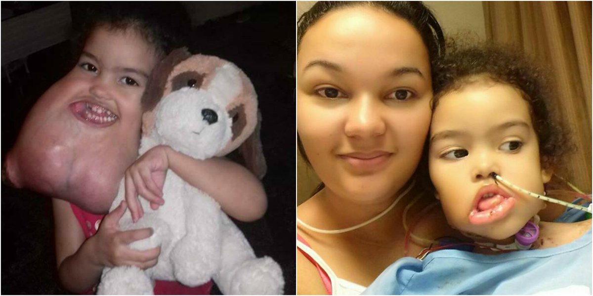 Shreveport surgeons remove rare tumor from girl's face - | WBTV Charlotte