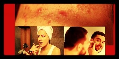 #TeenAcne when it is #MorethanaPimple https://t.co/X1oHQbnEfD updated from 2016 https://t.co/iXKzawaAbP