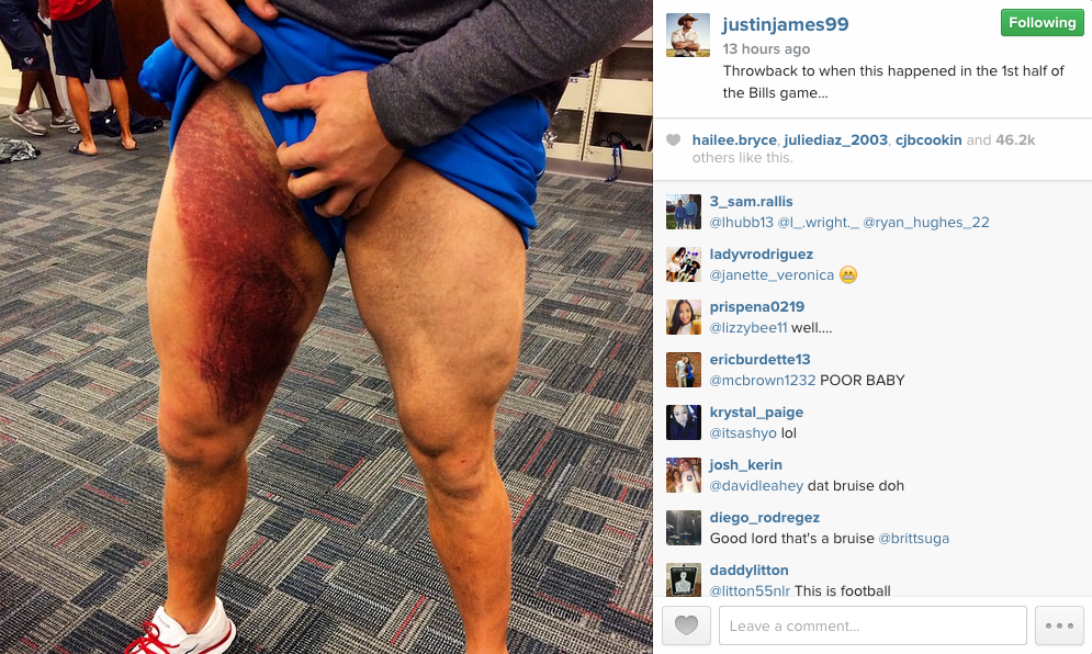 Jj watt thigh bruise