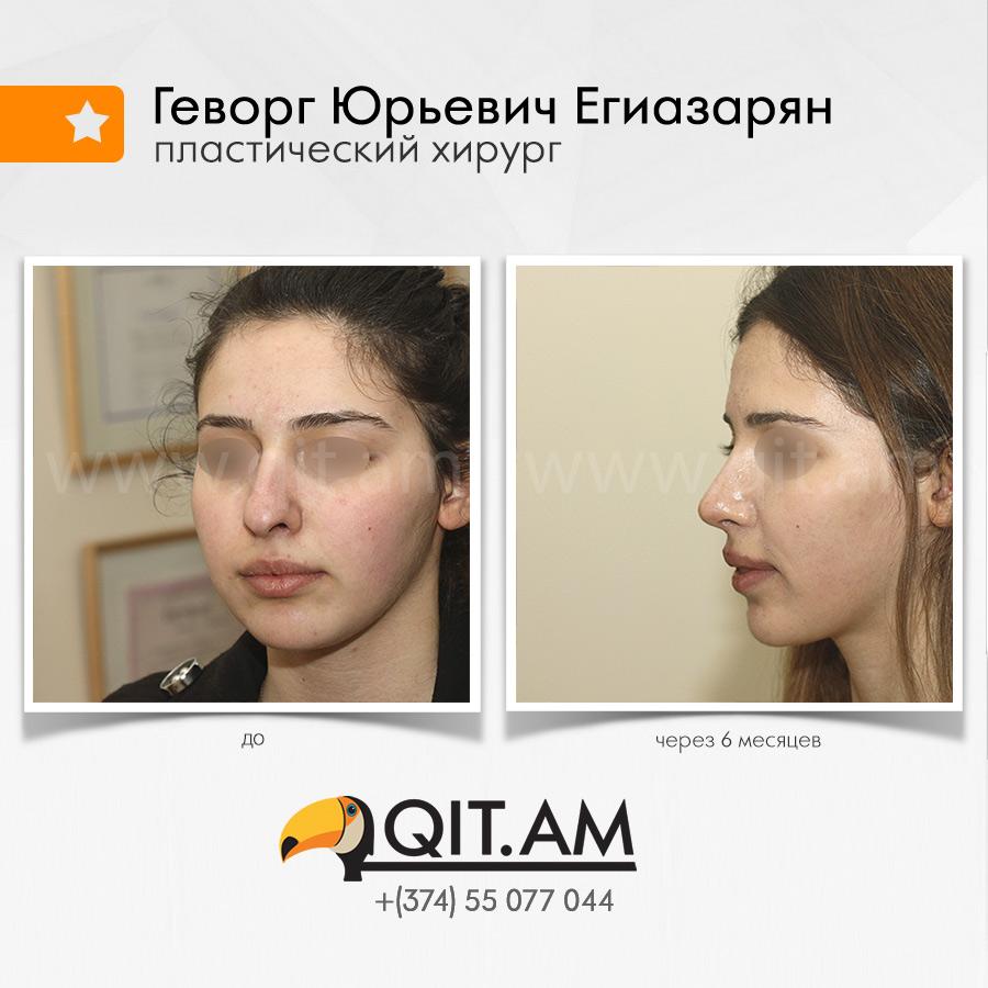 Ринопластика у егиазаряна отзывы Ринопластика у егиазаряна отзывы