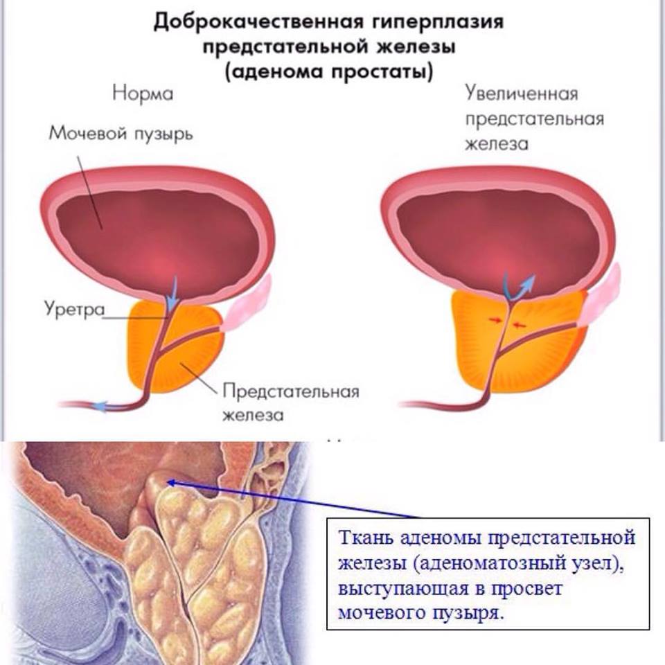 Диета При Гиперплазии Предстательной Железы