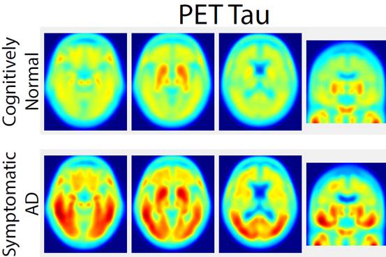 New Imaging Tech Could Help Scientists Better Understand Alzheimer’s https://t.co/q7UPx9bHFx by @JeanneWhalen https://t.co/zVjkA7vLrE