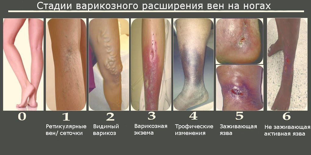 Как вылечить варикозное расширение вен в домашних условиях