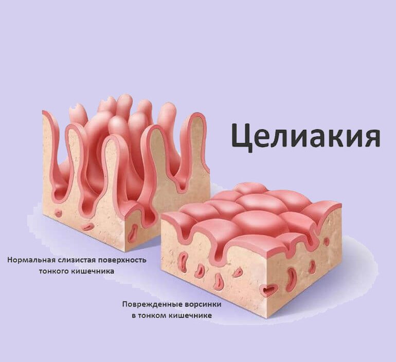 Диета При Целиакии Назначается