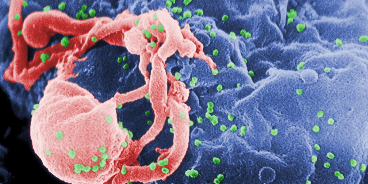 Girl’s HIV infection in remission without AIDS drugs