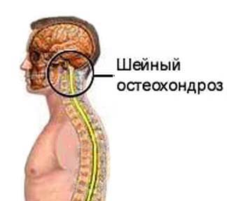 Экстрасистолия при остеохондрозе Экстрасистолия при остеохондрозе