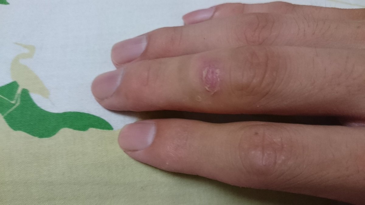 やっと治ってきた。なかなか時間かかるもんだな。。『飛影の邪眼でてこねぇかな』とか『寄生獣のミギーみたいにならねぇかな』と やっと治ってきた。なかなか時間かかるもんだな。。『飛影の邪眼でてこねぇかな』とか『寄生獣のミギーみたいにならねぇかな』と