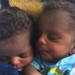 Conjoined DRC twins survive grueling journey to separation