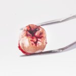 Fake dentists ply brisk trade in Morocco