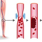 Cómo entender la enfermedad vascular periférica (EAP) | Diario El Mundo