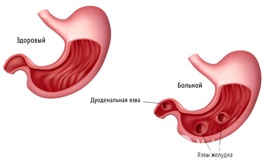 Язва Желудка И Двенадцатиперстной Кишки Симптомы Лечение И Диета