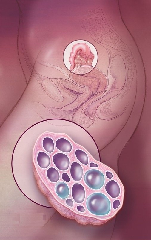 Диета При Мультифолликулярных Яичниках Чтобы Забеременеть Форум