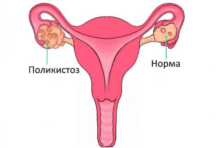 Диета При Поликистозе Яичников Меню На Каждый