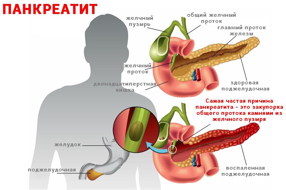 Панкреатит Признаки Лечение Диета