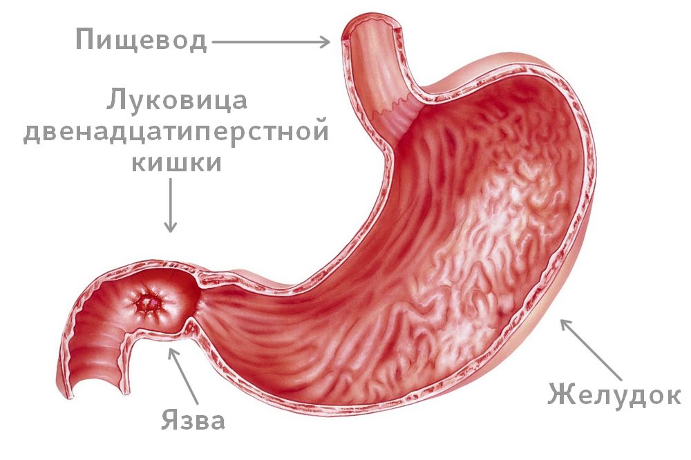 Язва 12 Перстной Симптомы Диета Лечение