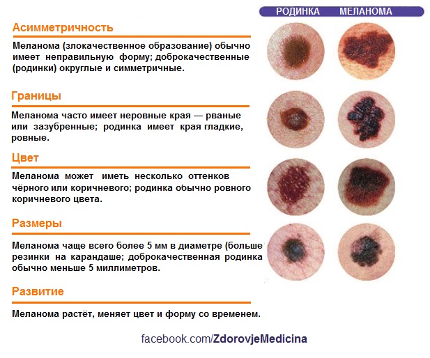 Диета При Меланоме 2 Стадии
