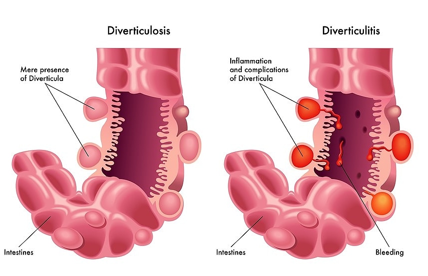 Дивертикулез Кишечника Симптомы Диета