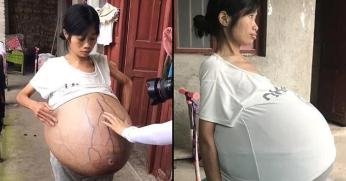 原因不明 中国に住む女性がまるで風船のようにお腹が膨らむ謎の症状に苦しめられる ニコニコニュース