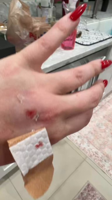 1 pic. I might have broken my wrist.. I got hit with a 50 miles per hour ball https://t.co/IXiNqy0Nm