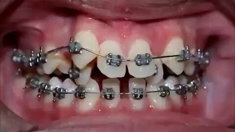 牙套究竟是如何一步步矫正牙齿的？ 
