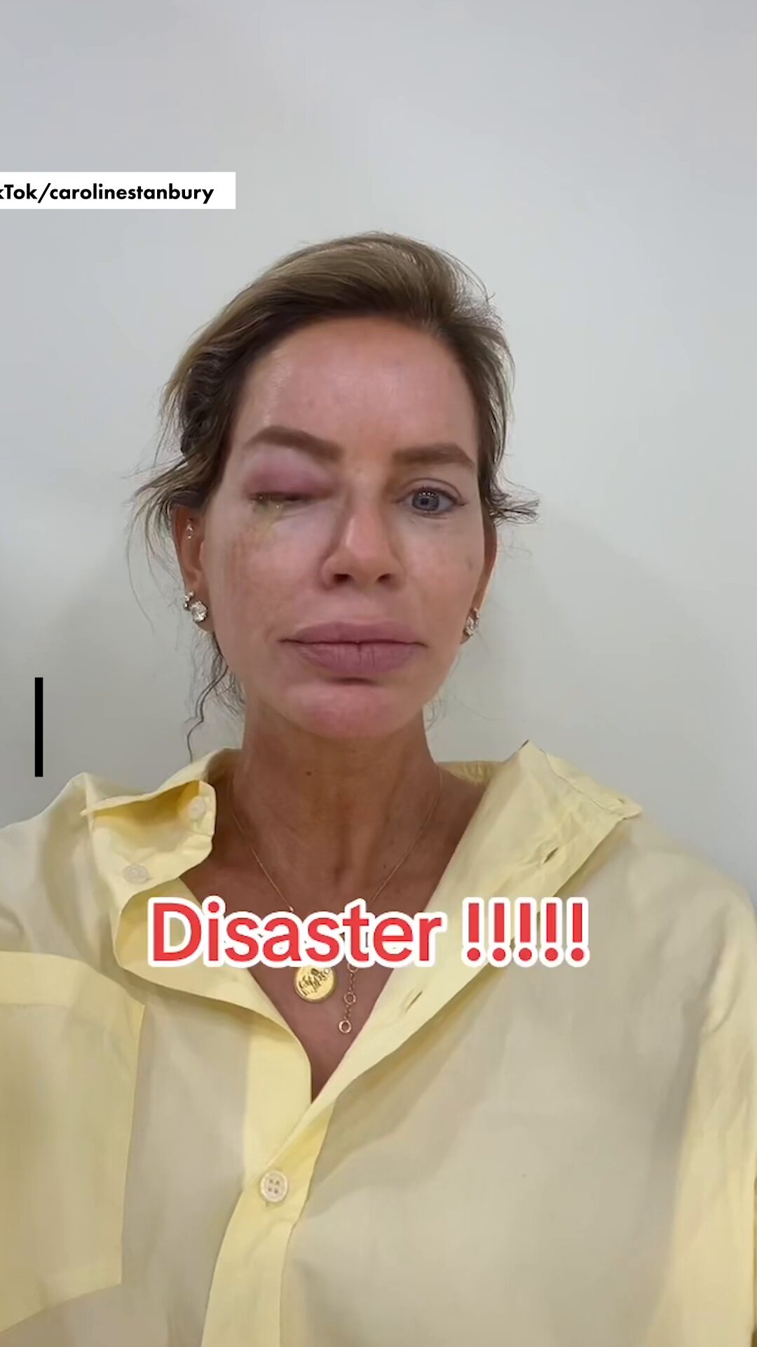 Real Housewives' Caroline Stanbury Battles Severe Eye Infection