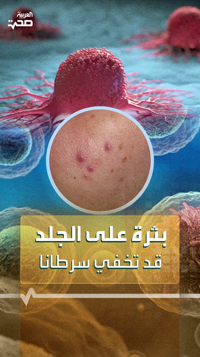 قد تظنها عادية.. بثرة على الجلد قد تكون سرطانا مميتا _صحة #صحة