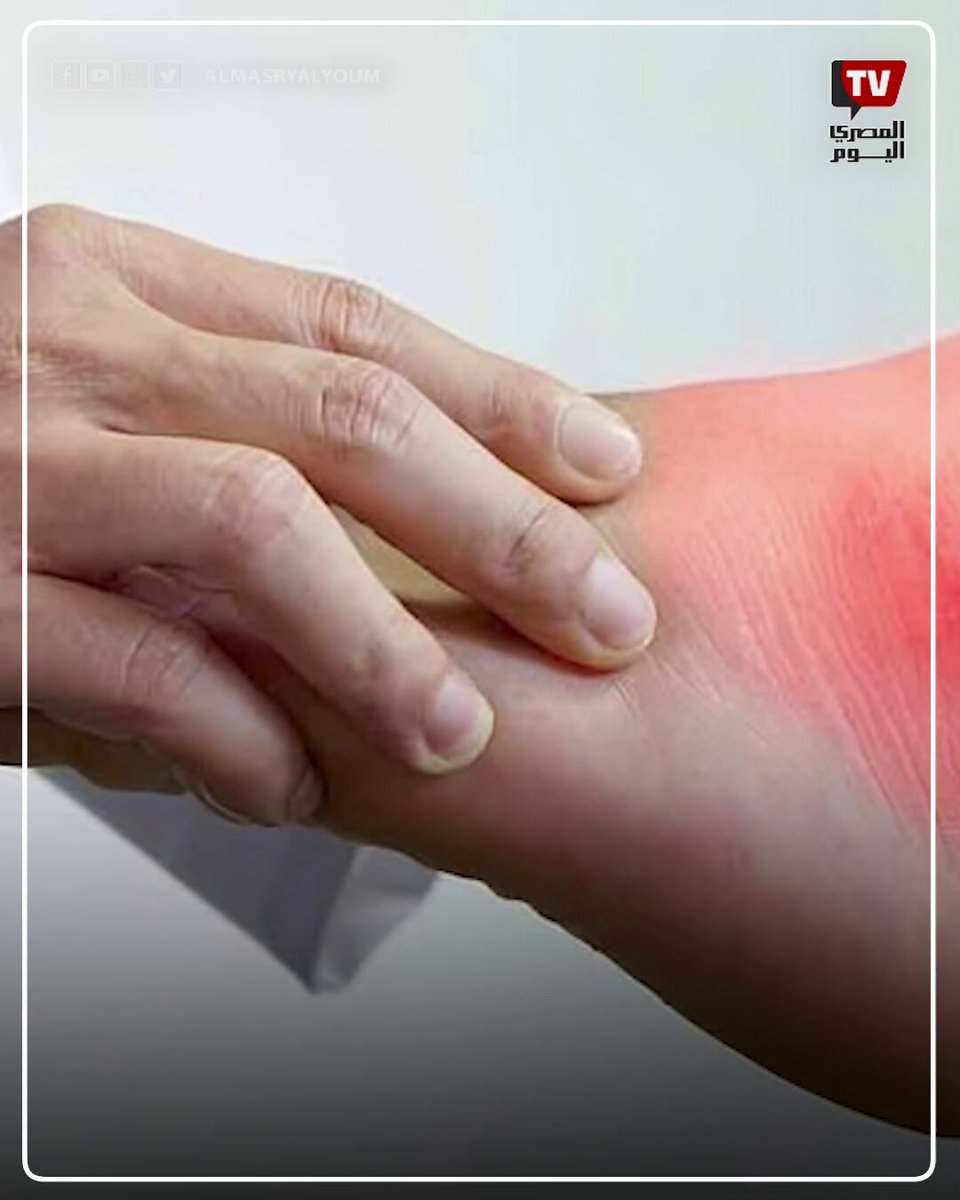 لكل مريض نقرس.. كيف تستمتع بالعيد دون ألم؟ 