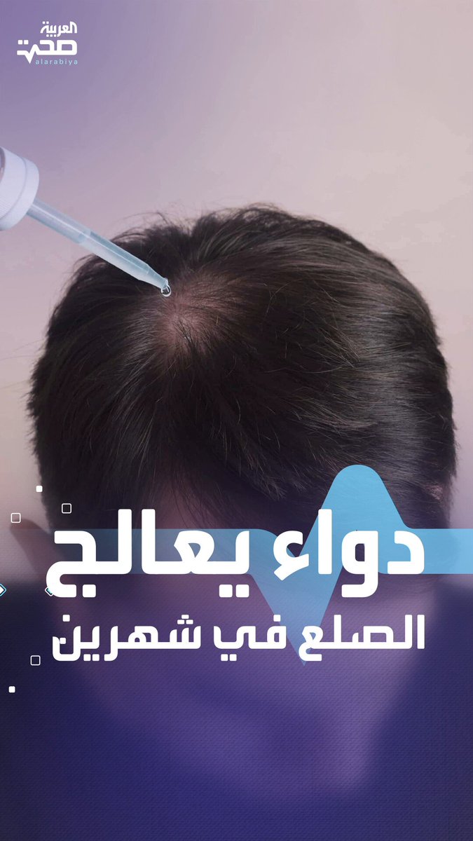 نموّ الشعر في 8 أسابيع فقط.. علاج واعد للصلع _صحة #صحة 