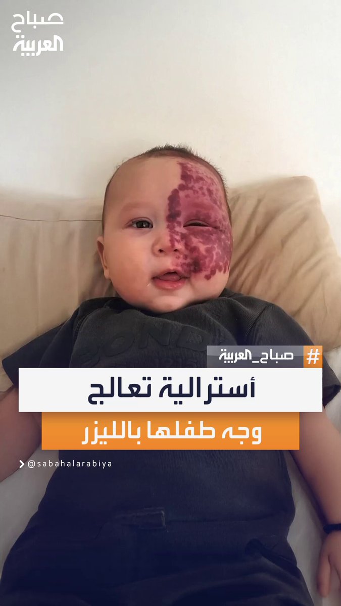أم أسترالية تواجه التعليقات السلبية بشجاعة وتقرر علاج وجه ابنها بجلسات ليزر لتمنحه ثقة أكبر بنفسه #صباح_العربية 