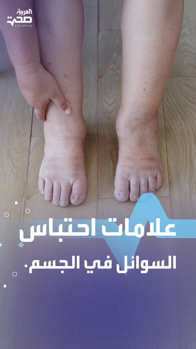 علامات احتباس السوائل في الجسم لا تتجاهلها صحة _صحة 