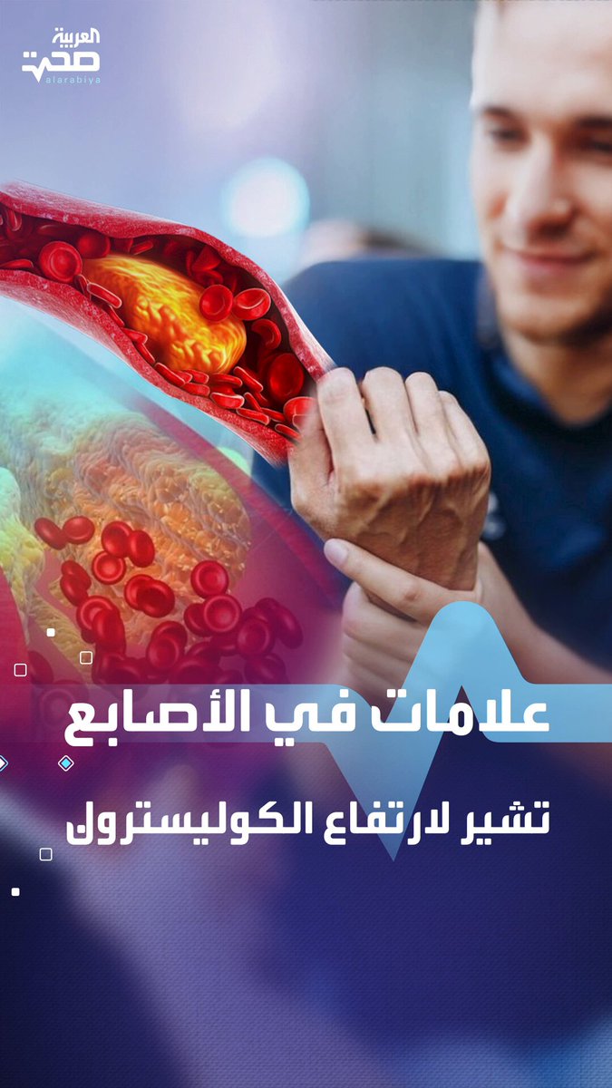 أعراض على أصابعك قد تكشف ارتفاع الكوليسترول.. تعرف عليها صحة _صحة 