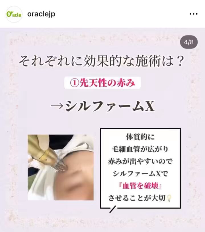 Oracle美容皮膚科と同じものです✴︎ ◤肝斑の治療症例◢| 《治療内容》 エンライトン ピコトーニング