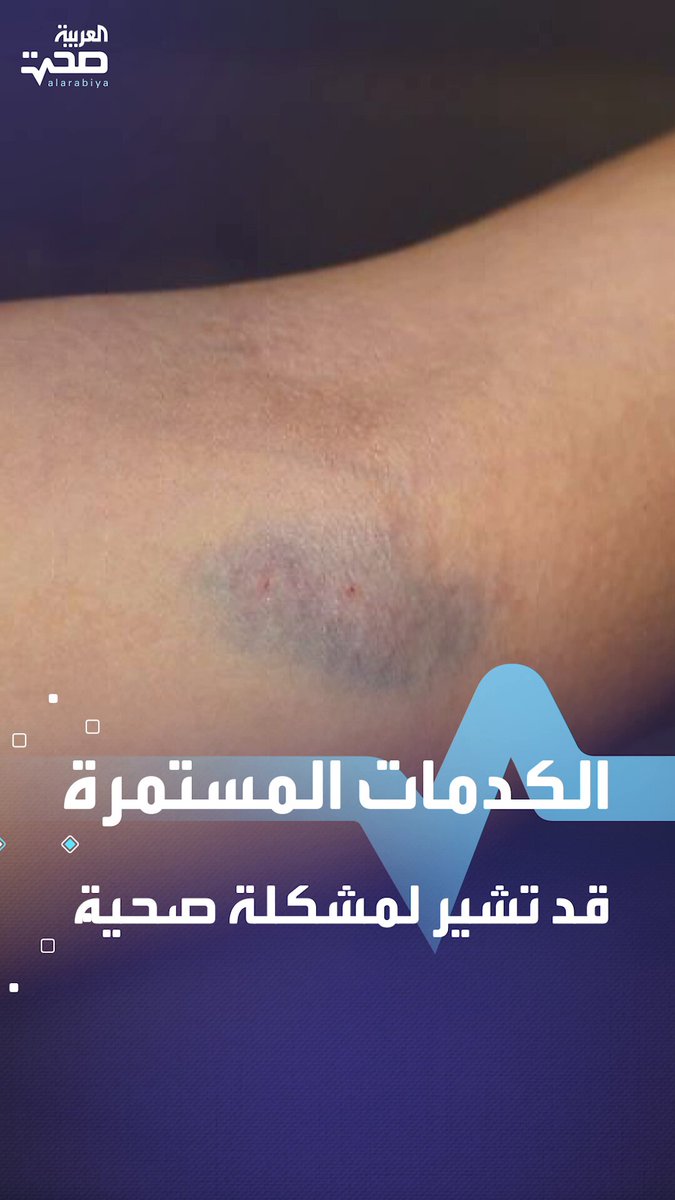 أسباب استمرار الكدمات ومتى يجب زيارة الطبيب صحة _صحة أسباب استمرار الكدمات ومتى يجب زيارة الطبيب صحة _صحة