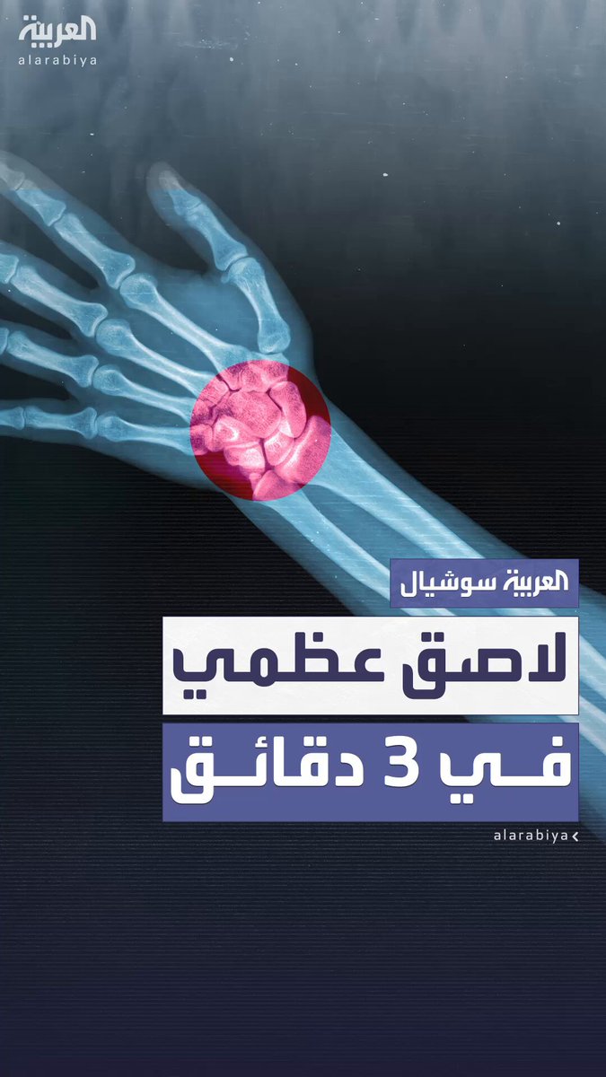 "جُرب بنجاح على 150 مريضا".. فريق بحثي صيني يعلن عن تطوير لاصق عظمي يثبت العظام البشرية خلال دقائق فقط 