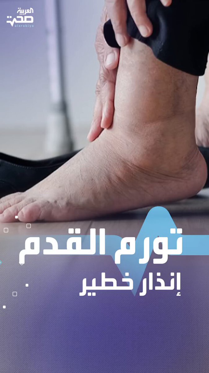 تورم القدم إنذار خطير 