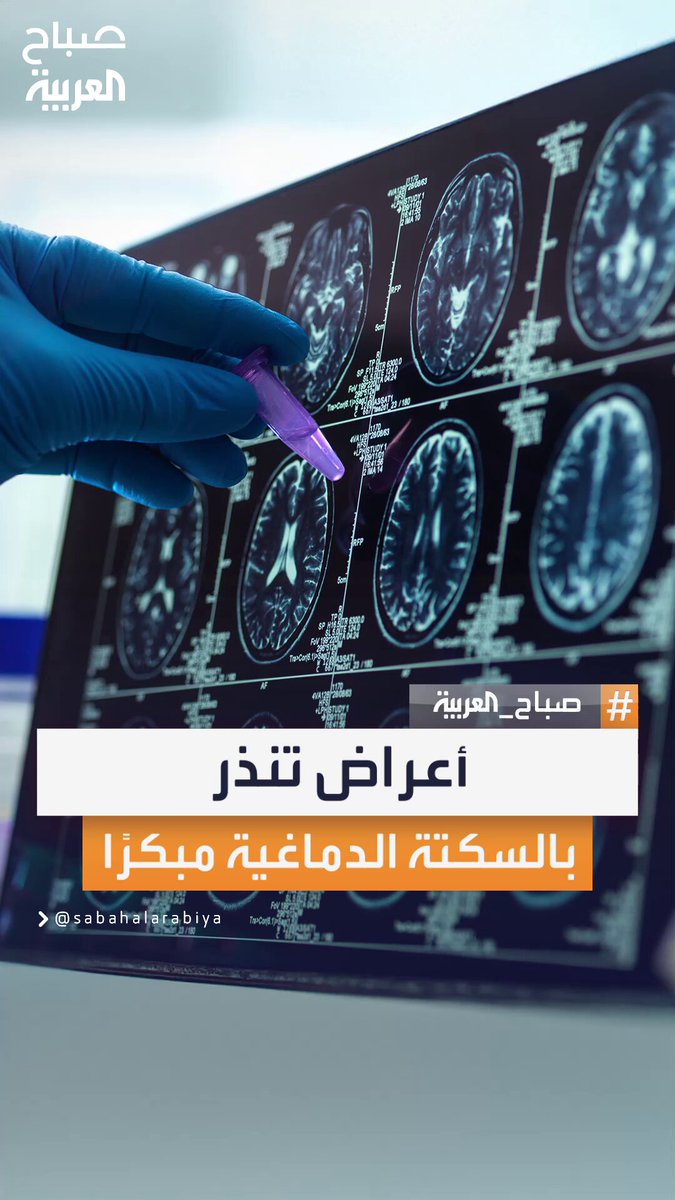 اختصاصي جراحة المخ والأعصاب محمد ملحم يحذر من علامات مبكرة قد تُنذر بالإصابة بالسكتة الدماغية ويدعو إلى التدخل السريع #صباح_العربية 