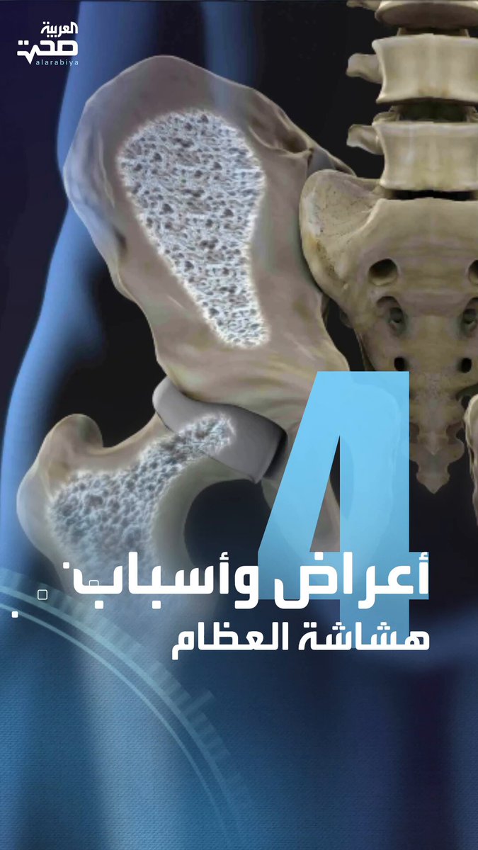 انتبه لهذه الأعراض.. قد تكون مصابا بهشاشة العظام دون أن تدري صحة _صحة 