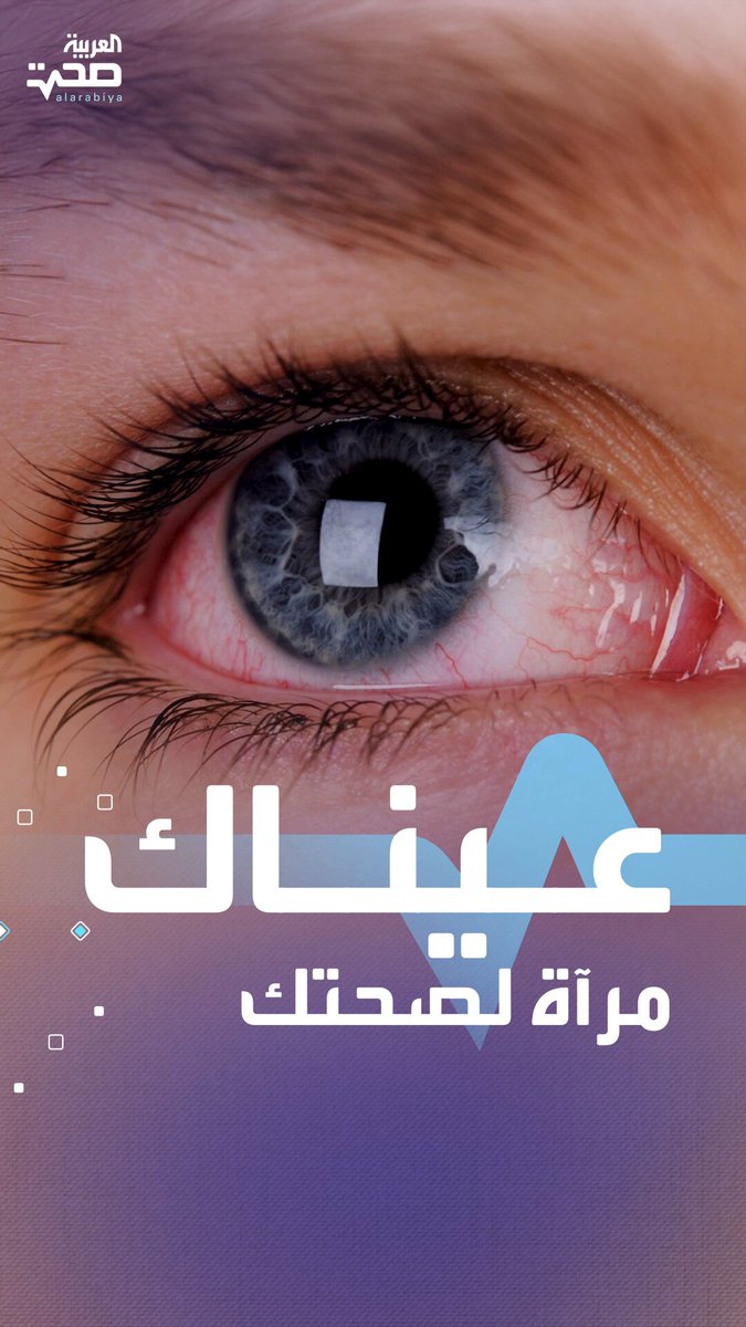 علامات في العين قد تُشير إلى حالات صحية خطيرة صحة _صحة 