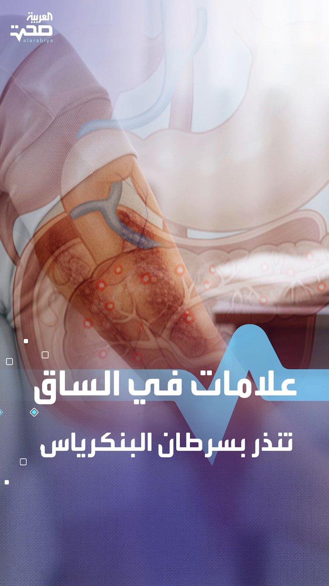 أربع علامات في الساق قد تكشف إصابتك بسرطان البنكرياس صحة _صحة 