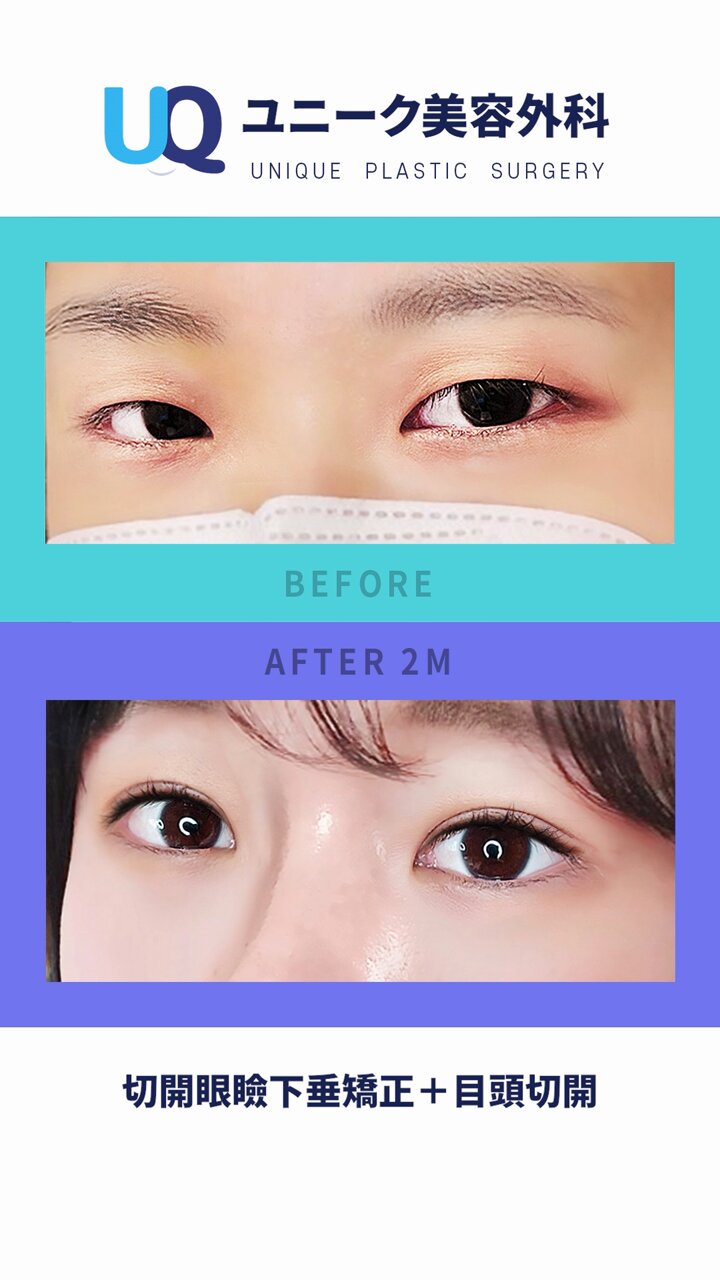 美容眼瞼下垂手術テキスト（英語版） 美容眼瞼下垂手術テキスト（英語版） 眼瞼下垂の最新治療特集