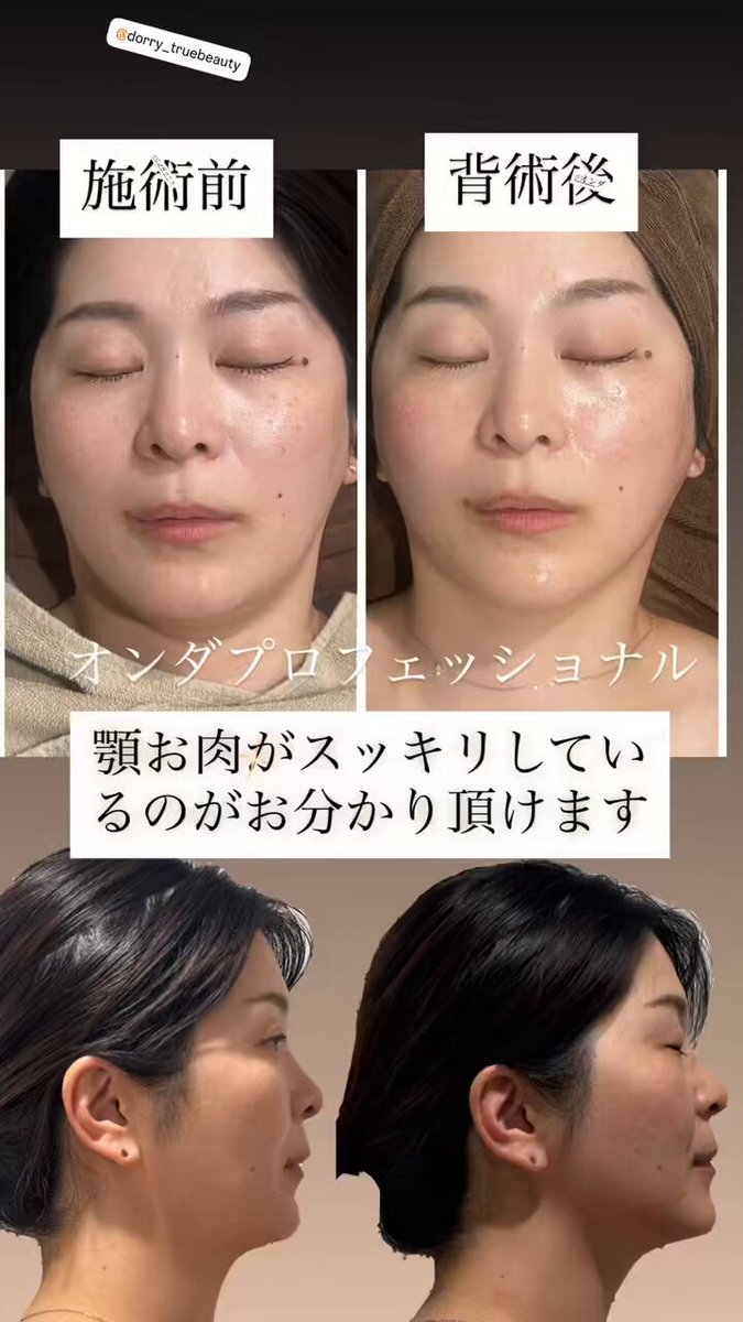 いまだけキャンペーン！冷却 脂肪冷却 2ハンドル いまだけキャンペーン