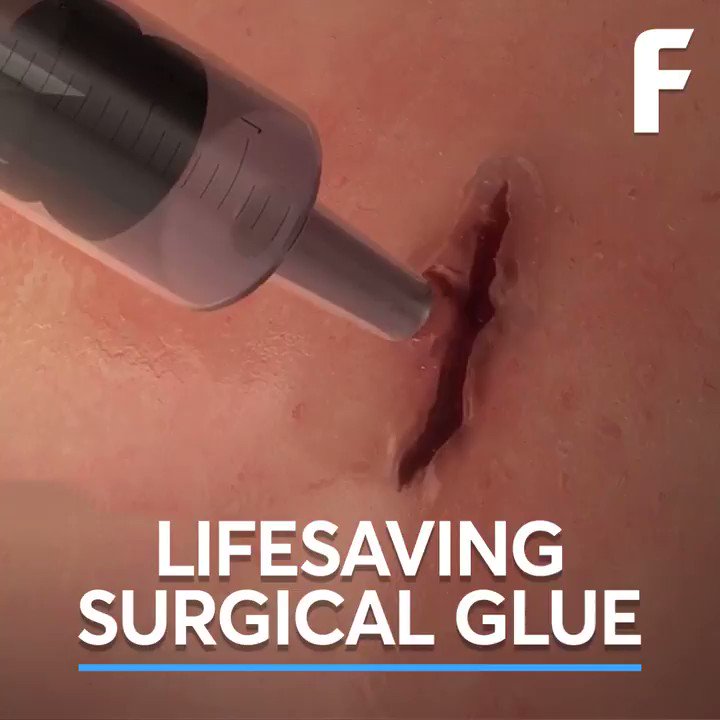 Futurism on X: This surgical glue instantly seals wounds   / X