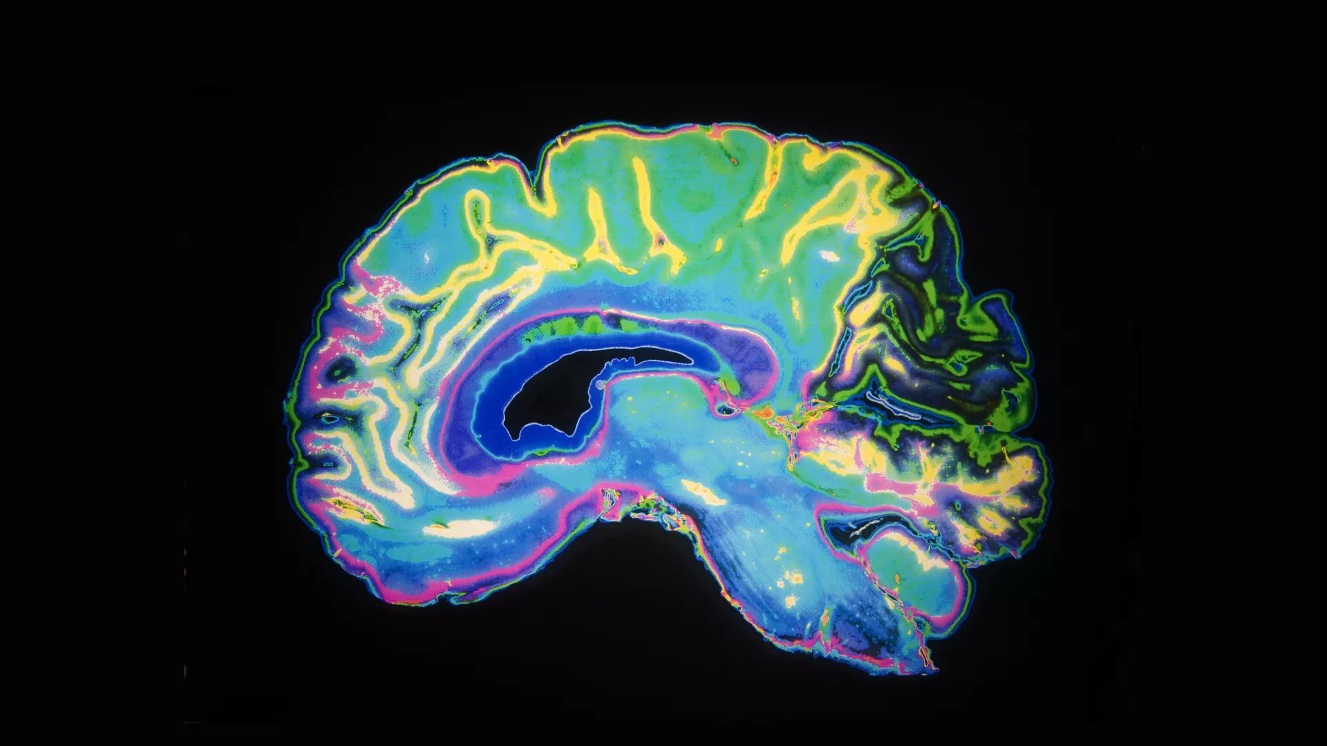 FrontNeurosci's tweet card. IntroductionThe study aims to evaluate symptomatic differences through psychometric tools comparing patients in the early stages of psychotic development wit...