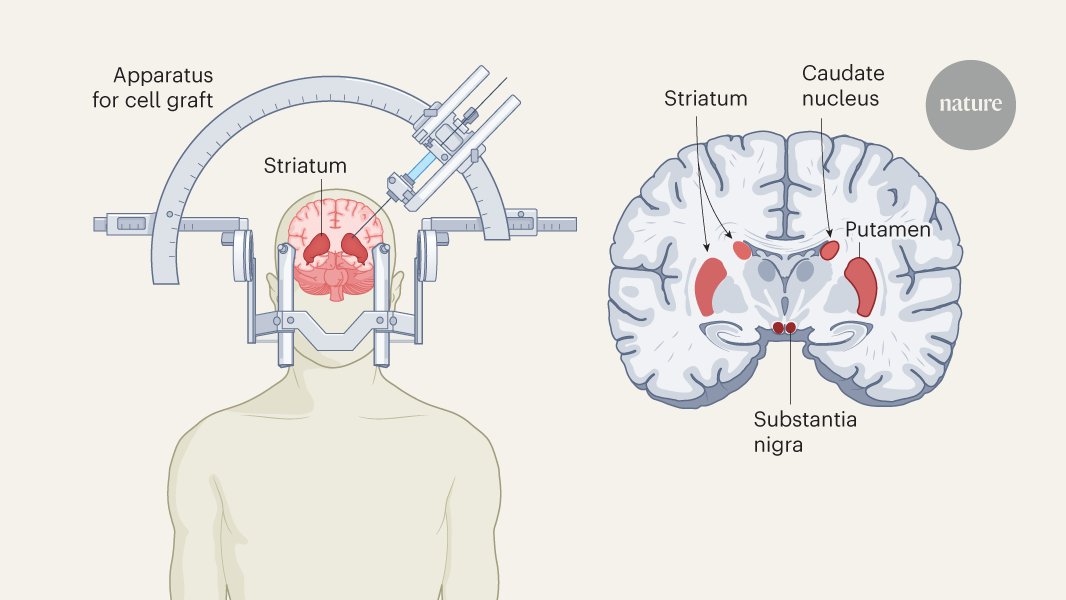 GeorgeTofaris's tweet card. Nature - Transplanting dopamine-releasing neurons into the brain is a promising regenerative therapy for Parkinson’s disease. Two clinical trials show that it is safe, but more evidence is needed...
