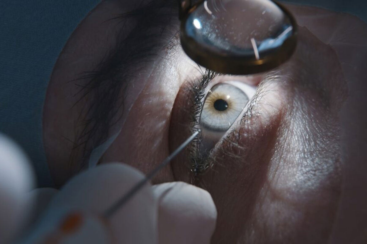 UCF's tweet card. Cataracts affect more than 65 million people worldwide and are a leading cause of vision loss and blindness.