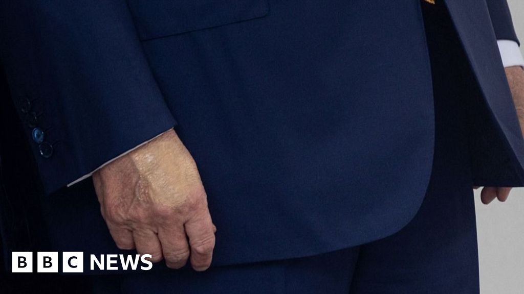 BernieDebusmann's tweet card. The president's press secretary says bruising on his hands is consistent with damage from frequent handshakes while taking aspirin.