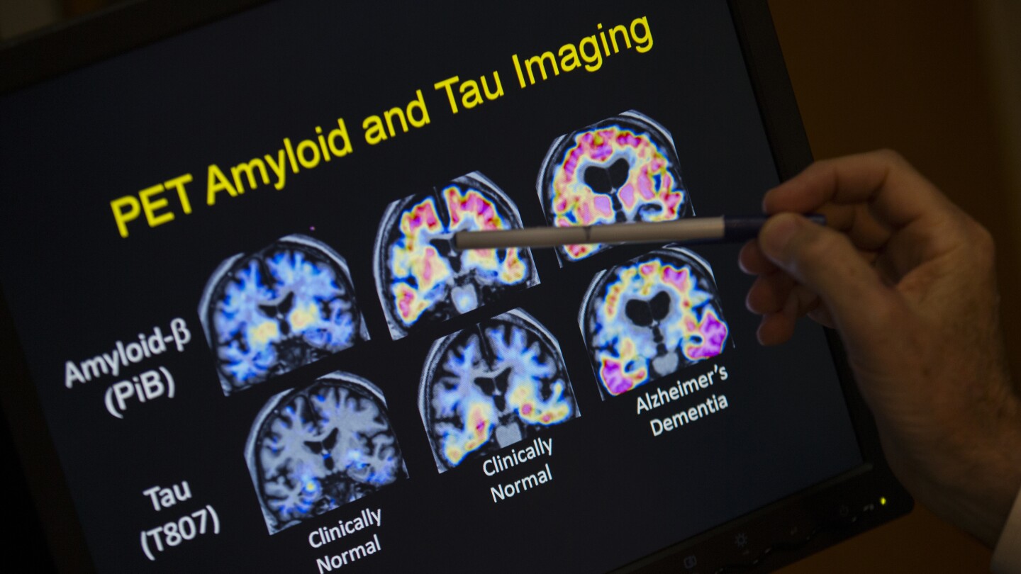 BillGates's tweet card. U.S. health officials have endorsed the first blood test that can help diagnose Alzheimer’s. The test would help identify patients who may benefit from drugs that can modestly slow the memory-destr...