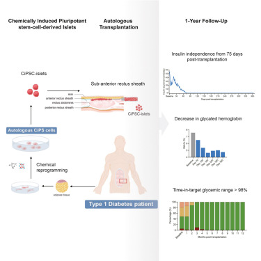 LabSancho's tweet card. Chemically induced stem-cell-derived islets were transplanted beneath the abdominal anterior rectus sheath in one patient with type 1 diabetes, resulting in tolerable safety and promising restoration...